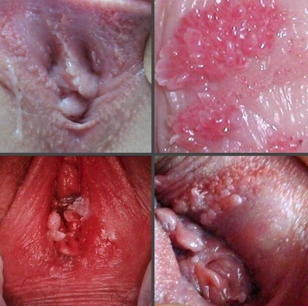 Gros plan des papillomes dans le vagin