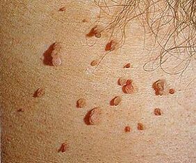 Papillomavirus humain sur la peau