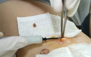 traitement chirurgical du papillomavirus humain